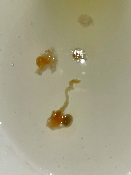 worms in human diarrhea